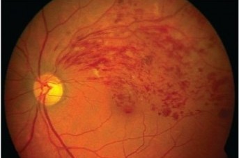 Diyabetik Retinopati