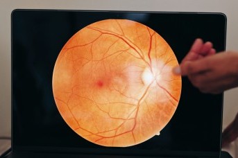 Prematüre Retinopatisi