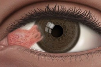 Pterjium (Göz Eti)